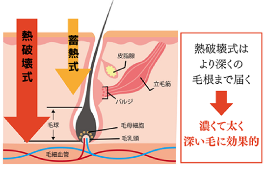 医療脱毛(ジェントルマックスプロ) | 西宮市の皮膚科・美容皮膚科の櫻根皮フ科